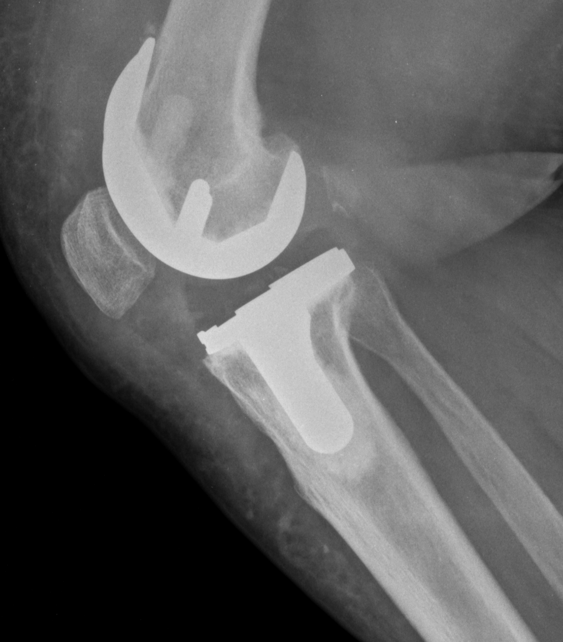 Radiografia de joelho com prótese total, incidência de perfil